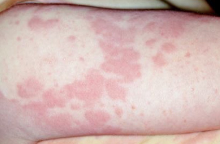 <p>Sensitivities to allergens- contact skin, nose, eyes, respiratory tract, GI tract</p><p>Drug allergies start on chest, spread to trunk and back- more significant on face  </p>