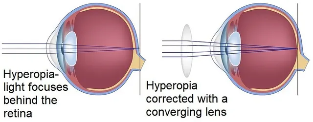 <ul><li><p>convex/converging lens</p></li></ul><p></p>