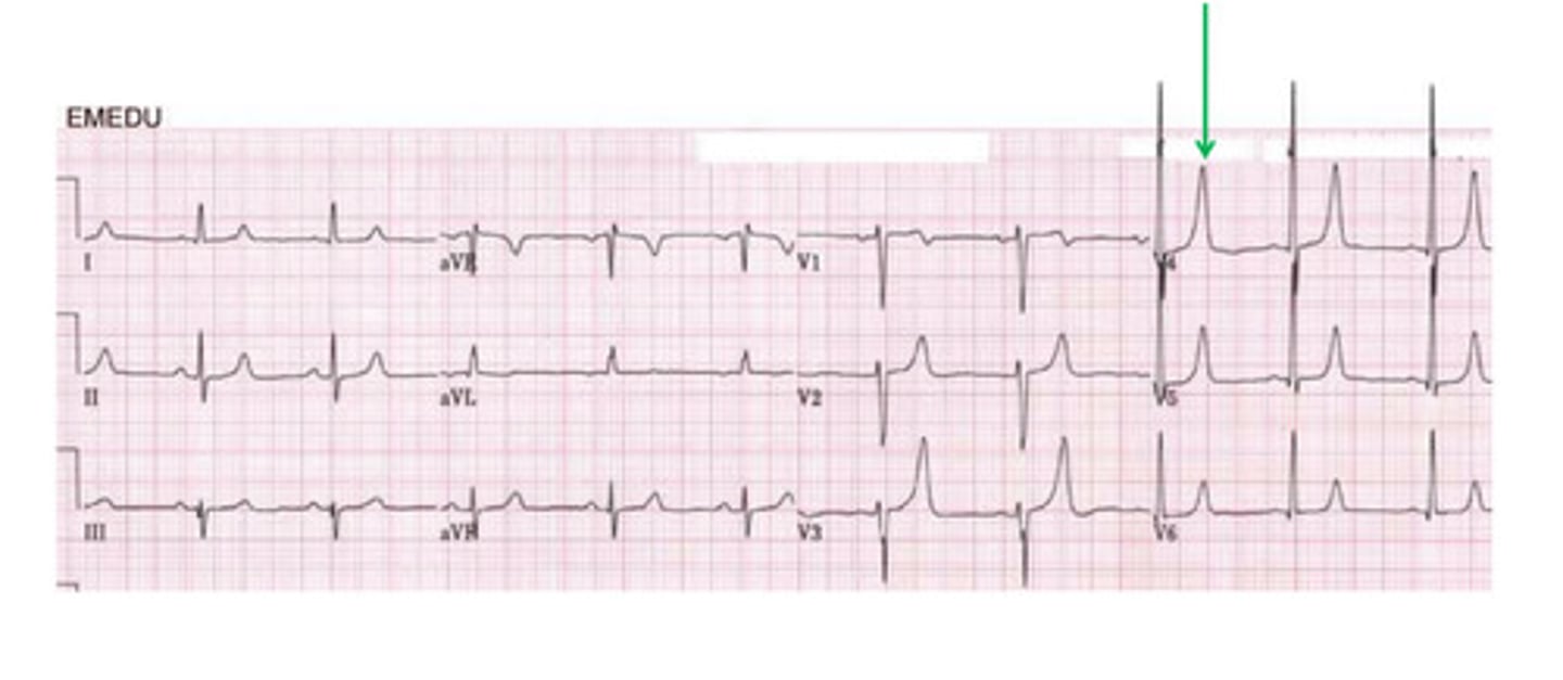 <p>this shows T wave peaking in _______</p>