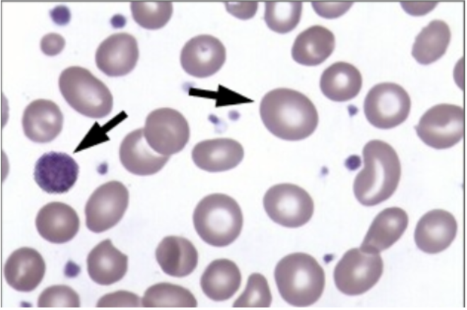 <ul><li><p><span style="background-color: transparent;"><strong>Maturation Defect</strong>: Decreased DNA synthesis</span></p></li></ul><ul><li><p><span style="background-color: transparent;">Normal to low retic</span></p></li><li><p><span style="background-color: transparent;"><strong>Differential Diagnosis</strong>: Vitamin B12 deficiency, folic acid deficiency</span></p></li></ul><p></p>