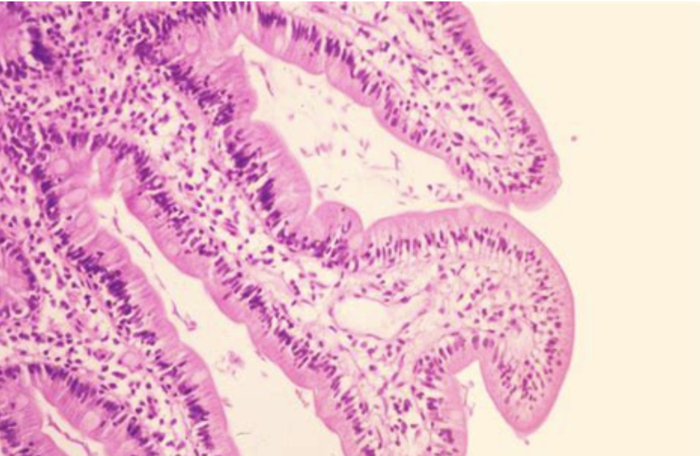 <p>Patient avec diarrhée </p><p>1) diagnostic </p><p>2) site préférentiel </p><p>3) histologie </p>