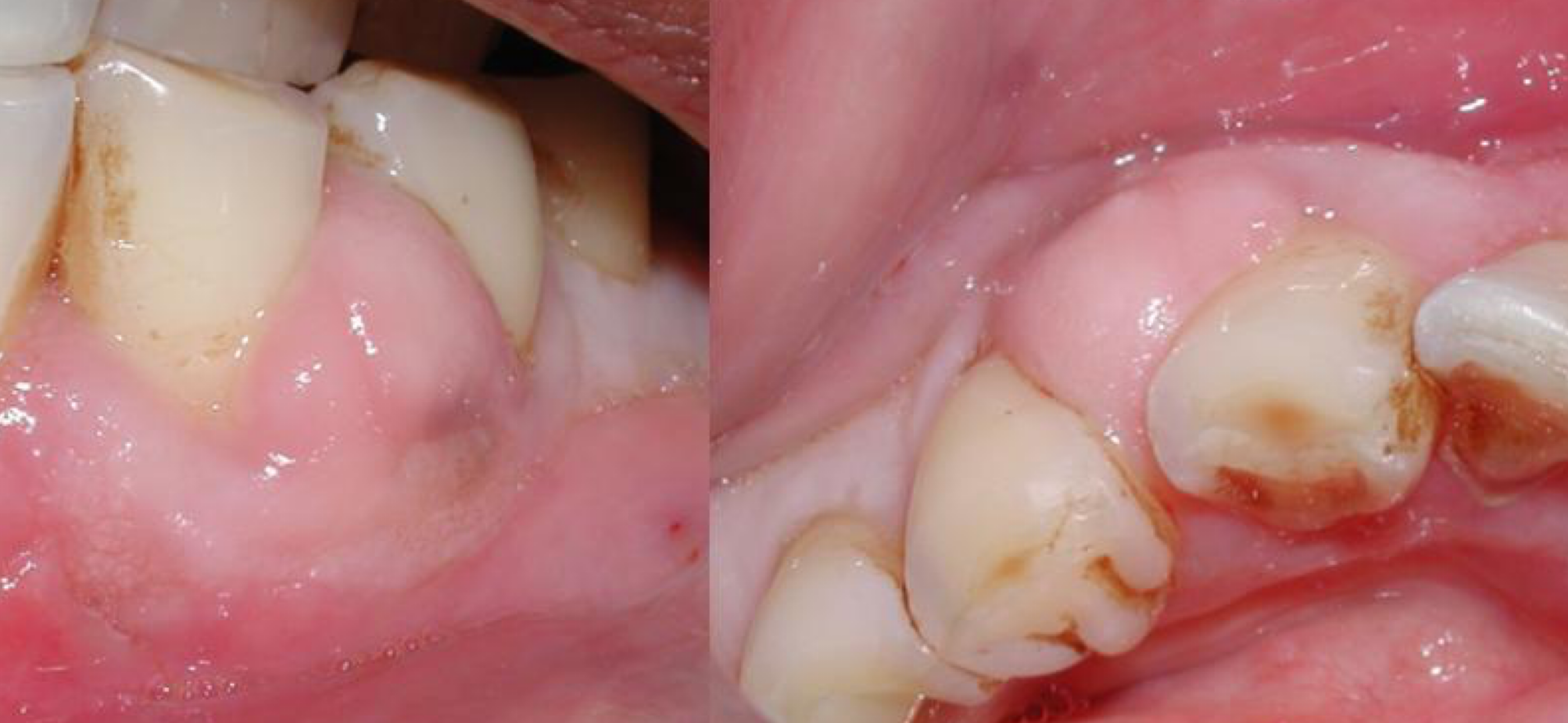 <ul><li><p>Localized, painful sudden onset</p></li><li><p>Bacterial infection post-trauma (e.g., embedded popcorn, fingernail) </p></li><li><p>Managed via debridement, irrigation, drainage</p></li></ul><p>(no PARL, no adj caries, etc)</p>