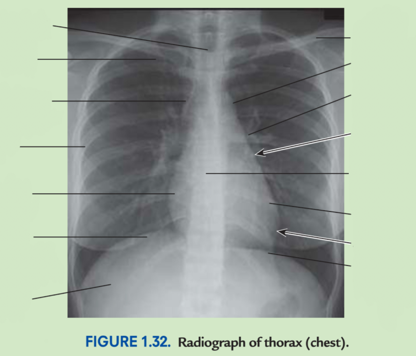 <p>Label chest X-ray</p>