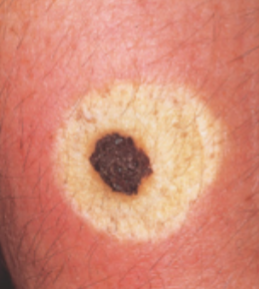 <p>halo nevus</p>