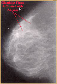 <p>mixed density breasts are composed of glandular tissue infiltrated with adipose tissue </p>