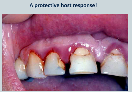 <p>gingivitis can be a protective host response </p>