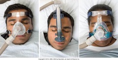<p>obstructive sleep apnea</p>