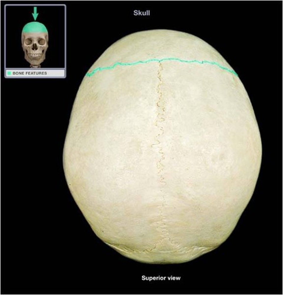 <p>Between frontal &amp; parietal bones</p>