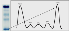 <p>What type of gammopathy is being shown in this plasma protein electrophoresis graph?</p>