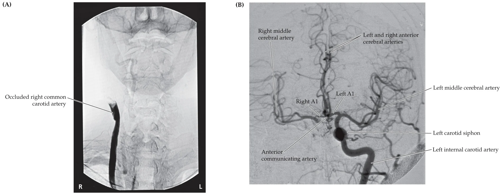 <p>right tempoparietal region, Right MCA inferior division </p>