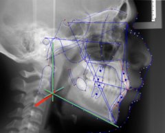 <p>which anatomical landmark:</p><p>- The intersection of the mandible and the line that bisects the angle formed by Menton-Gonion and Articulare-Ramus Point</p>
