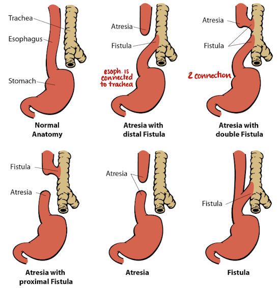 <ul><li><p>congenital <span style="color: red;">absence/blockage of esophagus</span></p><ul><li><p>esophagus fails to develop as a continuous passage</p></li><li><p>trachea and esophagus don’t separate → fistula</p></li></ul></li><li><p>often occurs with tracheoesophageal fistula</p></li><li><p>associated with <span style="color: yellow;">trisomy 18, 21</span></p></li><li><p>often <span style="color: red;">occurs with VACTERL</span> syndrome</p></li></ul><p></p>