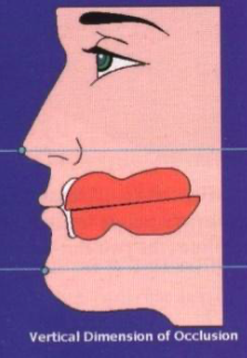 <p>vertical relation of occlusion (VRO/VDO)</p>