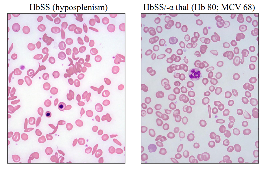 <p>Sickle Cell Disease</p>