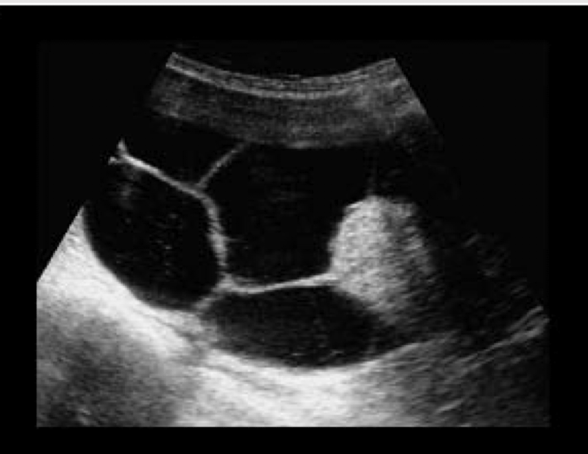 <p>second m/c benign tumour of ovary </p><ul><li><p>unilateral </p></li><li><p>unilocular or multiocular with thin septations </p></li><li><p>smaller than mucinous </p></li><li><p>borders irregular with loss of capsular definition </p></li><li><p>small amount of solid tissue </p></li></ul><p></p>