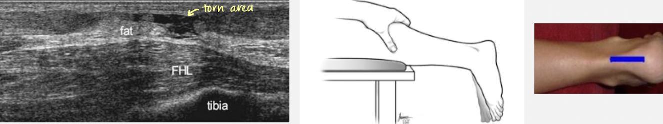 <ul><li><p>S/S: posterior ankle pain</p></li><li><p>transducer is placed misline above the heel; light touch; ample amount of gel; dorsiflexion (foot lifted towards the chin)</p></li><li><p>thompson to determine complete or partial tear (can’t flex if theres a complete tear)</p><ul><li><p>pt. prone, squeeze calf → foot should plantar flex when a complete tear is not present </p></li></ul></li></ul><p></p>