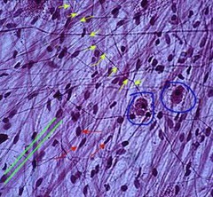 <p>Connective: (also called loose connective)characteristic Fibroblast cells, all three fibers visible in matrix(collagen, elastin & reticular).</p><p>Found in almost every part of the body. It surrounds blood vessels and nerves and penetrates with them into the small spaces of muscles, tendons, and other tissues.</p><p>Binds and provides cushioning</p>