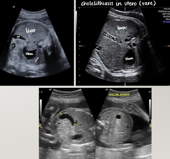<ul><li><p>seen after 20 weeks</p></li><li><p>SONO: elongated anechoic structure in long-axis; circle in short-axis</p></li><li><p>in right abdomen near liver</p></li><li><p>more oval than intrahepatic umbilical vein</p></li><li><p>document presence </p></li></ul><p></p>