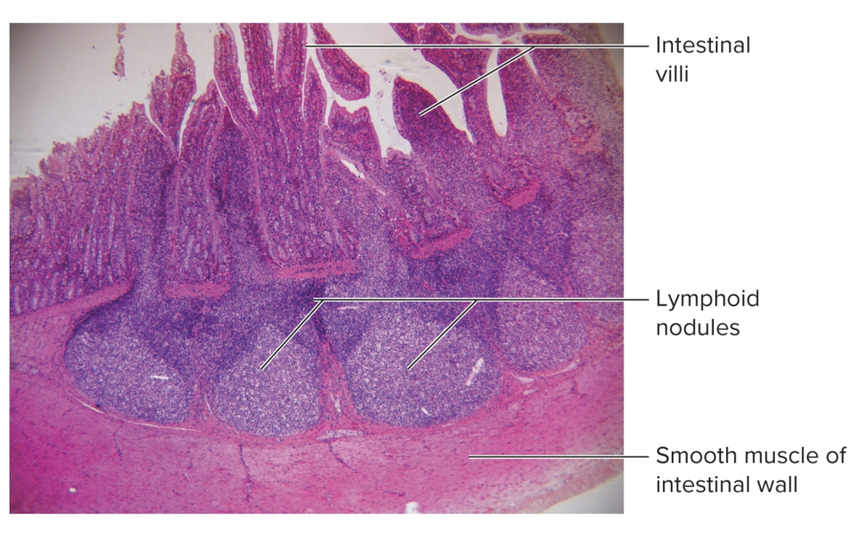 <p>where lymphocytes and macrophages gather in dense masses</p><ul><li><p>can be temporary/permanent on some tissues</p></li><li><p>pyres matches: lymphoid nodules in the small intestine</p></li></ul><p></p>
