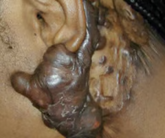 <p><strong>firm, raised, and often itchy skin growths that </strong><span><strong>extend beyond the boundary of an original injury</strong></span><strong>, caused by excessive collagen production during healing</strong></p>