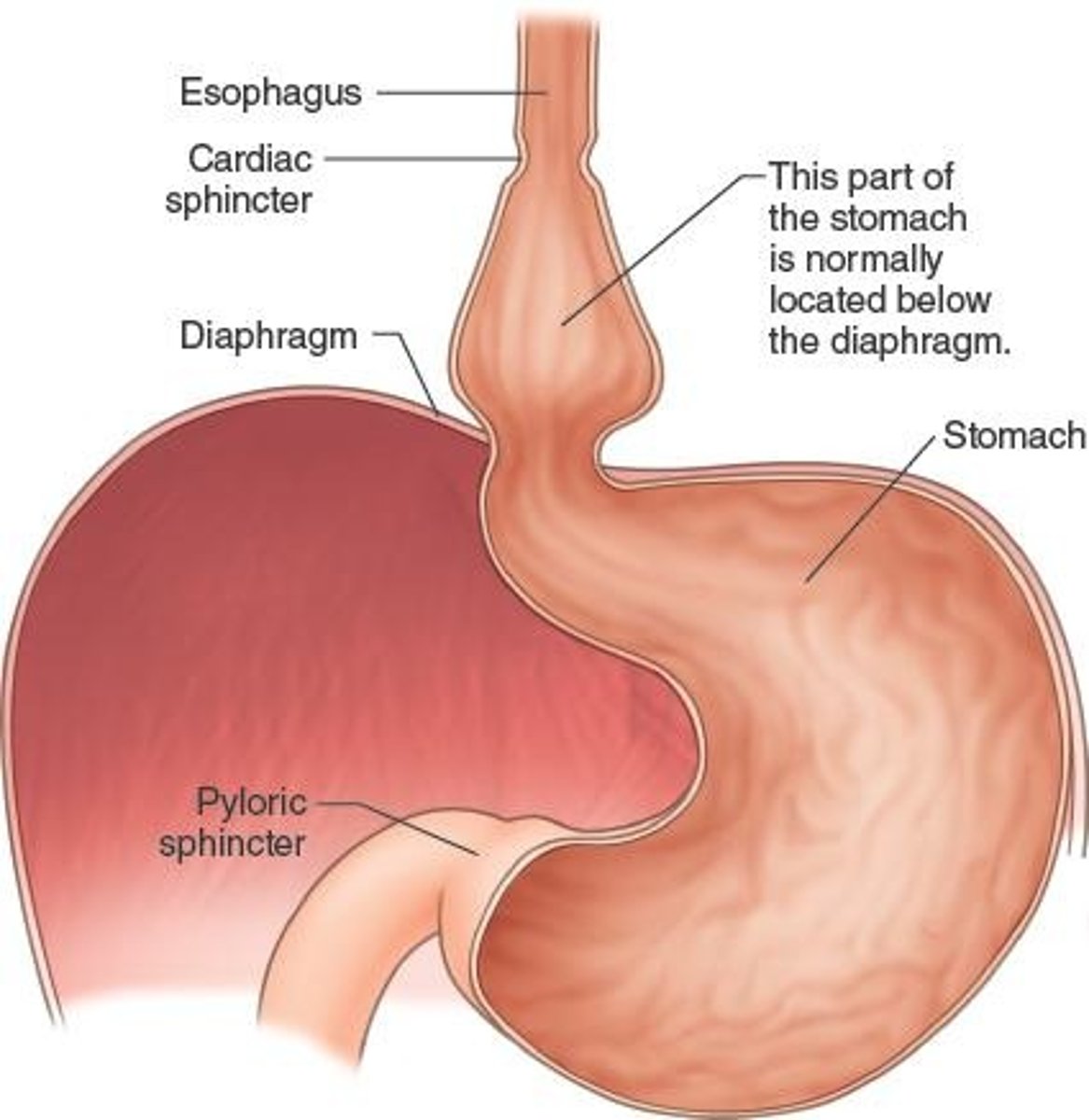 <p>An anatomical abnormality in which a portion of the stomach protrudes upward into the chest, through an opening in the diaphragm</p>