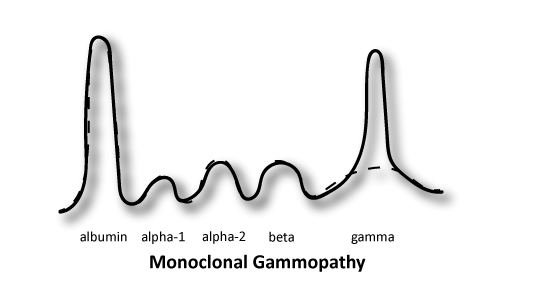 <p>large spike in GAMMA region</p><p><strong>Associated with Multiple myeloma, lymphoma, CLL, etc</strong></p>
