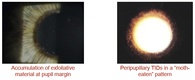<p>Pseudoexfoliative material can accumulate at the pupillary margin, appearing as flaky or dandruff-like material around the pupil.</p>