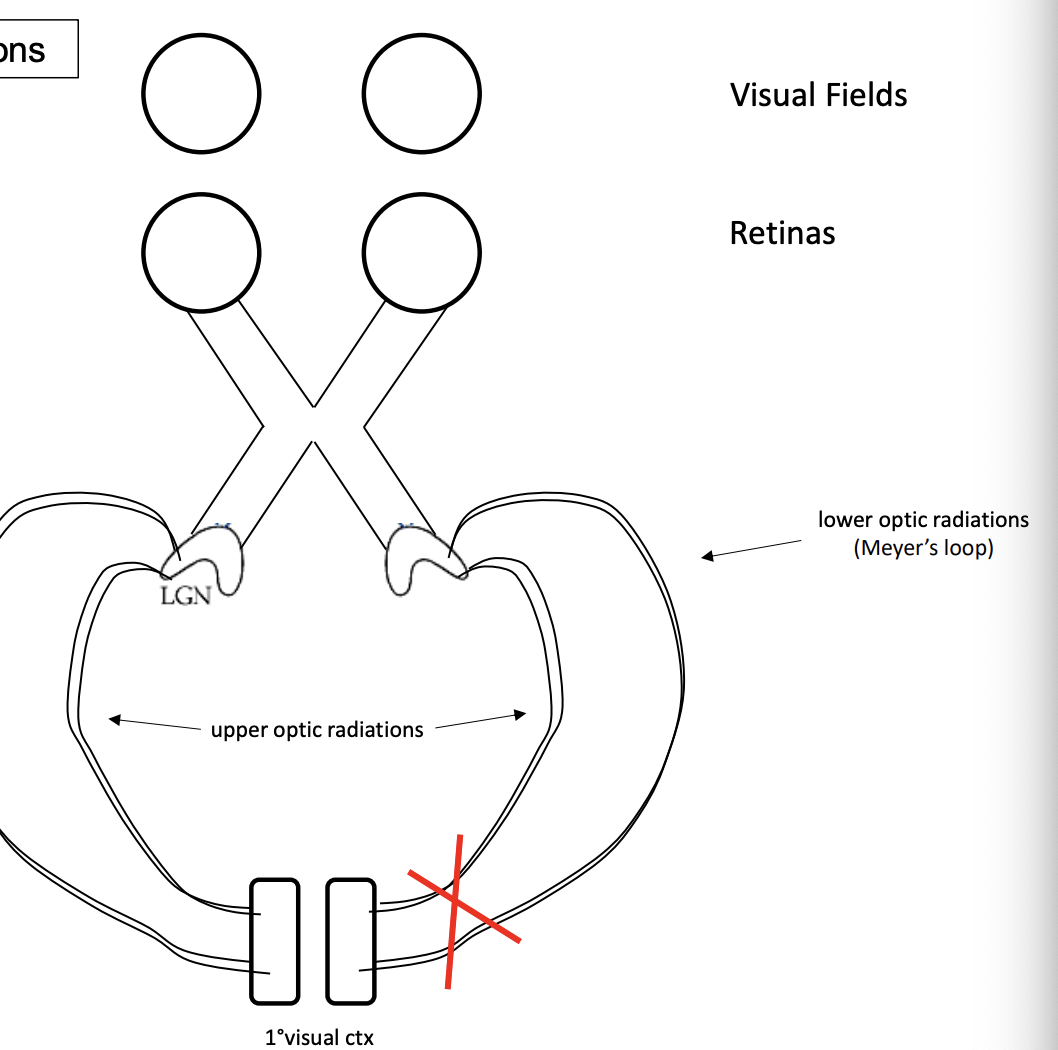 <p>cannot see out of left visual field </p>