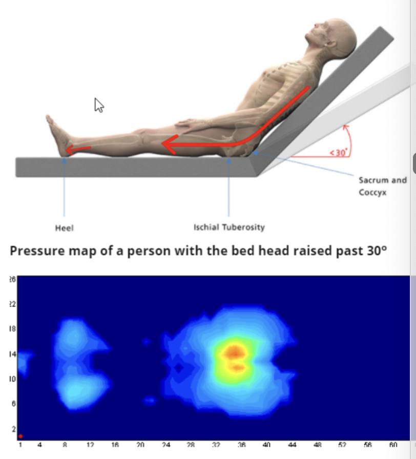 <ul><li><p>head of bed elevated >30 d increases pressure at sacrum</p></li><li><p>everything else the same as fully supine</p></li></ul><p></p>