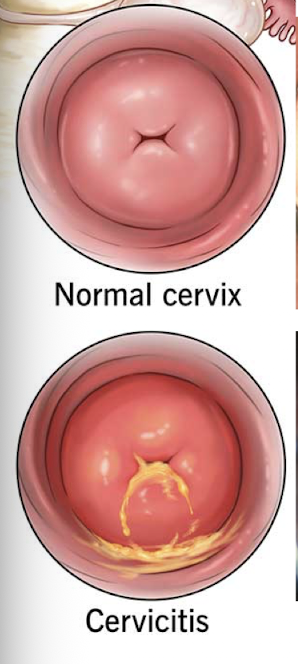 <ul><li><p>Red</p></li><li><p>Edematous (swollen)</p></li><li><p>mucopurulent exudate (draining from external os) </p></li></ul><p></p>