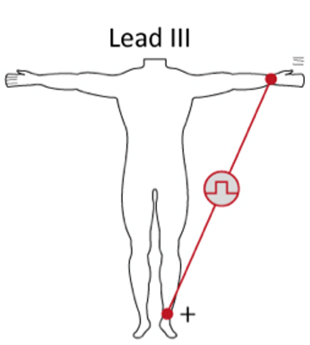 <p>Lead III</p>