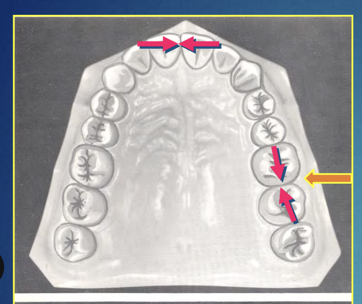 <p>The surfaces of teeth facing toward adjoining teeth in the same arch are termed as</p>