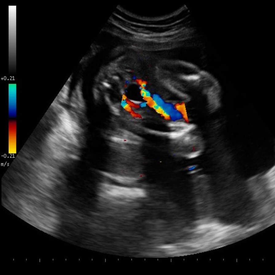<p>Which of the following statements correctly describes the image displayed?</p><p>A. The image demonstrates a two vessel cord.</p><p class="p1">B. The image demonstrates a transverse view of the fetus at the level of the stomach.</p><p class="p1">C. The image demonstrates a normal cord with two arteries.</p><p class="p1">D. The image demonstrates the lumbar spine and pelvic bones</p>