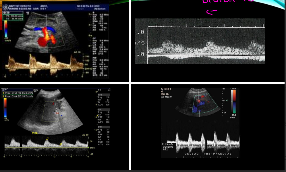 <p>this pt has sudden onset of abdominal pain, fever , dehydration, acidosis diagnosed by MRA whats there diagnosis? due to what?</p>