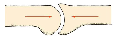 <p>Forces that compact, squeeze, or press inwards on tissue, typically acting along the longitudinal axis of bones and joints. (ex. dislocated shoulders- planks create compression force within their joint to help with better muscle activation and stabilization via compression)</p>