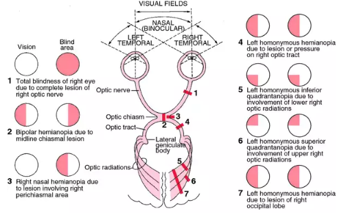 <p>Lesion en el quiasma optico</p>