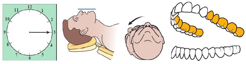<ul><li><p>Clinician in 3 o’clock position</p></li><li><p>Chin UP</p></li><li><p>Maxillary occlusal perpendicular to floor</p></li><li><p>Patient head: Neutral or slightly away from clinician</p></li></ul><p></p>