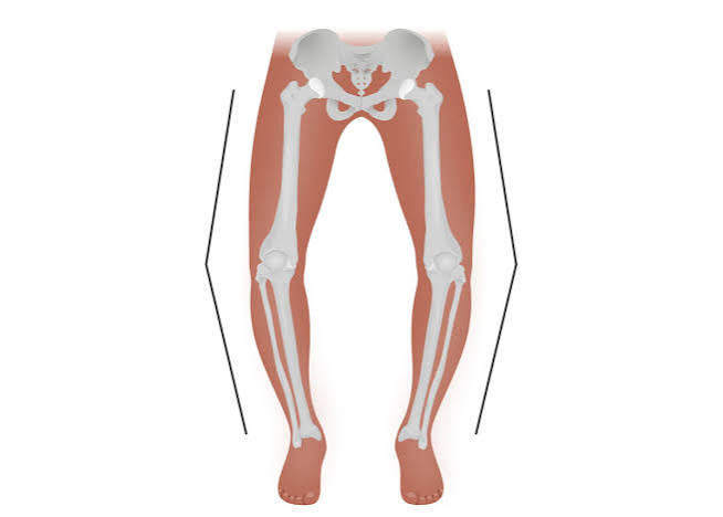 <p>bow leg, distal segment toward midline</p>