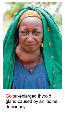 <ul><li><p><span style="font-family: "Arial (Body)";">Toxicity</span></p><ul><li><p><span style="font-family: "Arial (Body)";">Impairs thyroid function and reduces the synthesis and release of thyroxine</span></p></li></ul></li><li><p><span style="font-family: "Arial (Body)";"><u>Deficiency:</u></span></p><ul><li><p><span style="font-family: "Arial (Body)";"><strong>Simple goiter</strong>: Enlarged thyroid gland</span></p></li><li><p><span style="font-family: "Arial (Body)";"><strong>Secondary deficiency and goiter</strong></span></p><ul><li><p><span style="font-family: "Arial (Body)";">Goitrogens: Substances in food that reduce the use of iodine by the thyroid gland, resulting in goiter</span></p><ul><li><p><span style="font-family: "Arial (Body)";">Rutabagas, cabbage, soybeans, and peanuts</span></p></li></ul></li></ul></li></ul></li></ul><p></p><ul><li><p><span style="font-family: "Arial (Body)";">During pregnancy</span></p><ul><li><p><span style="font-family: "Arial (Body)";">Damage to brain of the developing baby</span></p></li></ul></li><li><p><span style="font-family: "Arial (Body)";">Cretinism (congenital hypothyroidism)</span></p><ul><li><p><span style="font-family: "Arial (Body)";">Severe deficiency</span></p></li><li><p><span style="font-family: "Arial (Body)";">Abnormal sexual development</span></p></li><li><p><span style="font-family: "Arial (Body)";">Mental retardation</span></p></li><li><p><span style="font-family: "Arial (Body)";">Dwarfism</span></p></li></ul></li></ul><p></p>