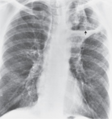 <p>This x-ray image indicates what pathology?</p>