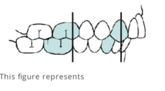 <p>jaw is positoned normally but the teeth are not meaning the teeth are malpostioned or rotated, etc.</p>