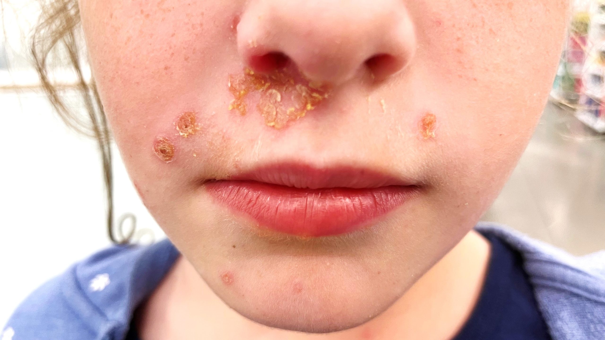 <p>A contagious bacterial skin infection.</p>