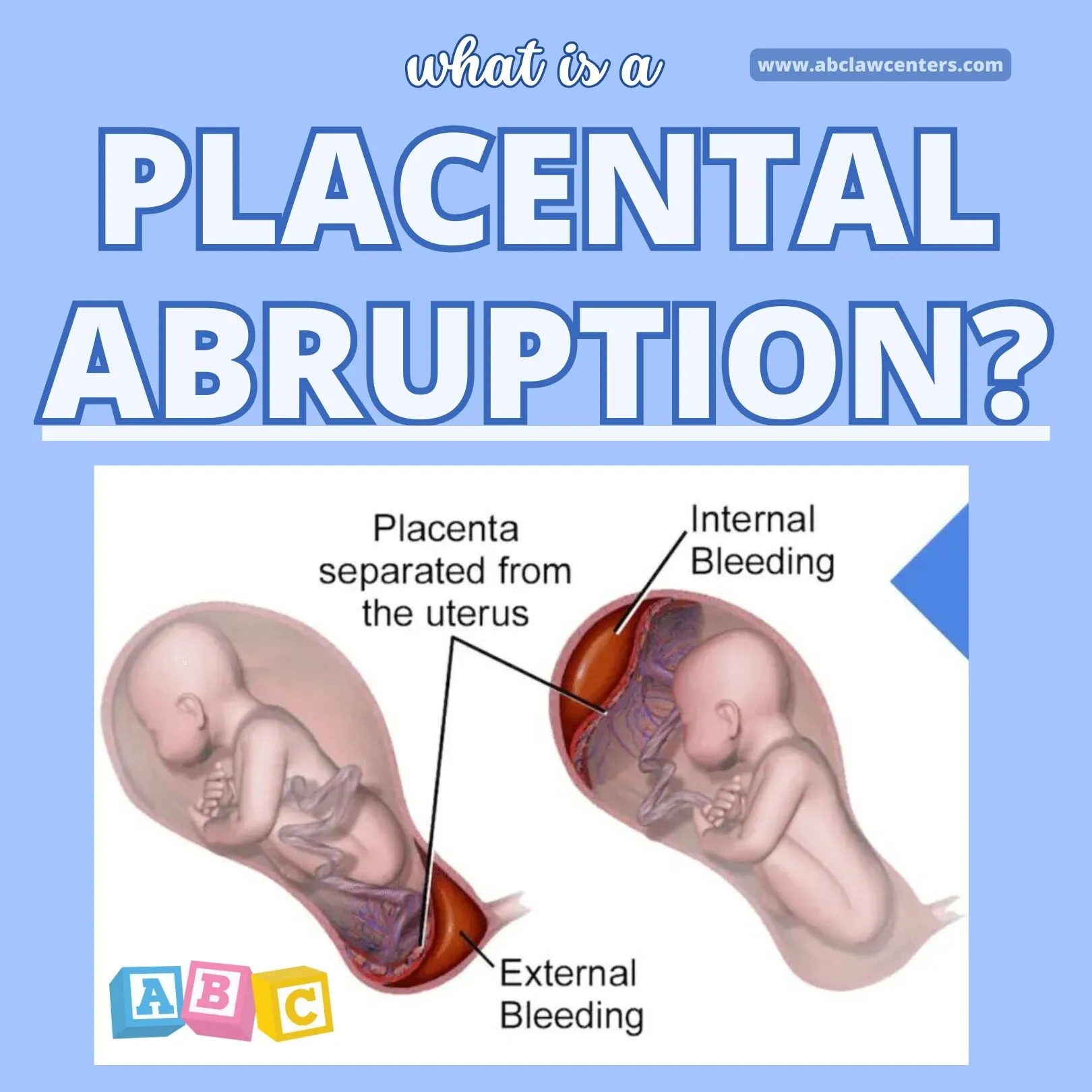 <p>A serious pregnancy complication where the placenta detaches from the uterus before delivery, leading to heavy bleeding and potential harm to both mother and baby. </p>
