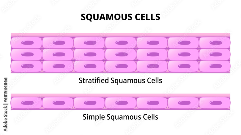 <p>Thin, flat, scaly </p><p>Bulge where nucleus is at </p><p>Kind of like a fried egg sunny side up </p><p>Found in: esophagus and form surface layer (epidermis) of skin</p>