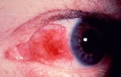 <p>Rheumatoid Atrhritis</p>