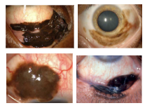 <p>What is the most likely diagnosis ?</p>