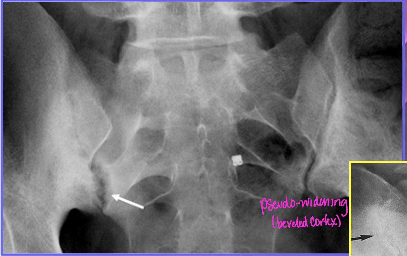 <p>Why is this image’s dx NOT Osteitis Condensans Ilii (OCI)</p>