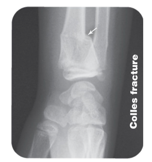 <p>fracture of the <strong>radius</strong> near the wrist (distal end), w broken end typically displaced backward</p>