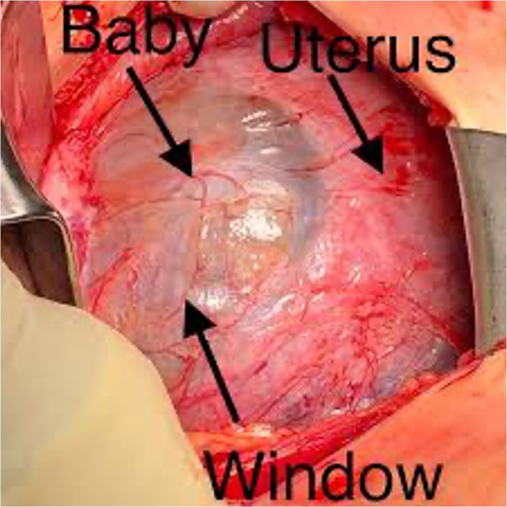 <ul><li><p><span>Refers to marked thinning of a prior uterine scar where the myometrium is so thin that the fetal membranes or even the fetus can be seen through it </span><strong><span>but the uterus has not fully ruptured</span></strong></p></li><li><p><span>Extremely thin lower uterine segment</span></p></li><li><p><span>Weak prior scar and increased risk of uterine rupture in future pregnancies</span></p></li><li><p><span>Usually recommended to not get pregnant again </span></p></li></ul><p></p><p></p>