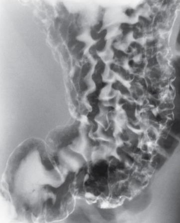 <p>Inflammation of the stomach mucosa.</p>